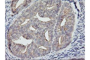 Immunohistochemical staining of paraffin-embedded Adenocarcinoma of Human endometrium tissue using anti-RTN4IP1 mouse monoclonal antibody. (RTN4IP1 抗体  (AA 41-279))