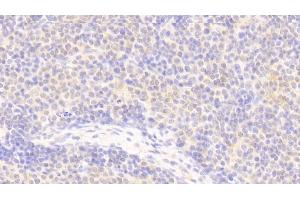 Detection of APBB1IP in Human Lymph node Tissue using Polyclonal Antibody to Amyloid Beta Precursor Protein Binding B1 Interacting Protein (APBB1IP) (Amyloid beta (A4) Precursor Protein-Binding, Family B, Member 1 Interacting Protein (APBB1IP) (AA 188-421) 抗体)