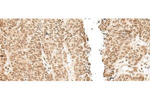 Immunohistochemistry of paraffin-embedded Human ovarian cancer tissue using LGALS4 Polyclonal Antibody at dilution of 1:30(x200) (GAL4 抗体)