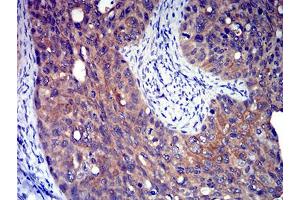 Immunohistochemical analysis of paraffin-embedded cervical cancer tissues using P2RY8 mouse mAb with DAB staining. (P2RY8 抗体)