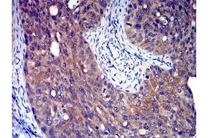 Immunohistochemical analysis of paraffin-embedded cervical cancer tissues using P2RY8 mouse mAb with DAB staining.