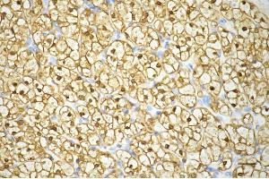 Immunohistochemistry was performed on paraffin-embedded human renal carcinoma using enolase 1 antibody (ABIN7798448), 1:200). (Recombinant ENO1 抗体)