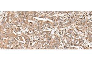 Immunohistochemistry of paraffin-embedded Human liver cancer tissue using FAAP24 Polyclonal Antibody at dilution of 1:30(x200) (FAAP24 抗体)