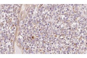 ABIN6273208 at 1/100 staining Human lymph cancer tissue by IHC-P. (CHCHD4 抗体  (N-Term))