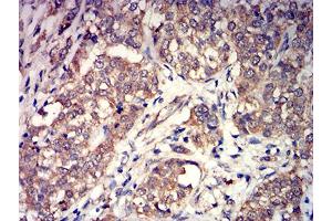 Immunohistochemical analysis of paraffin-embedded bladder cancer tissues using GRM3 mouse mAb with DAB staining. (Metabotropic Glutamate Receptor 3 抗体  (AA 433-576))