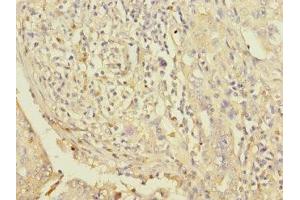 Immunohistochemistry of paraffin-embedded human lung cancer using ABIN7163118 at dilution of 1:100 (Lipin 1 抗体  (AA 741-890))