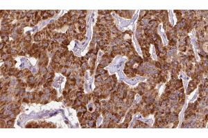ABIN6267144 at 1/100 staining Human thyroid cancer tissue by IHC-P. (NEDD4-2 抗体  (pSer448))