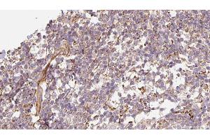 ABIN6276608 at 1/100 staining Human Melanoma tissue by IHC-P. (DEFB121 抗体  (Internal Region))