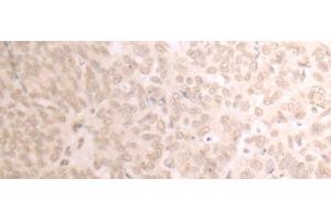 Immunohistochemistry of paraffin-embedded Human ovarian cancer tissue using TRMT1 Polyclonal Antibody at dilution of 1:25(x200)