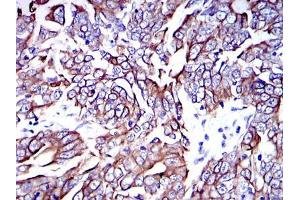 Immunohistochemical analysis of paraffin-embedded human stomach cancer tissues using KRT19 mouse mAb with DAB staining. (Cytokeratin 19 抗体)
