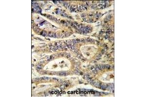 Formalin-fixed and paraffin-embedded human colon carcinoma reacted with IGFBP6 Antibody (C-term), which was peroxidase-conjugated to the secondary antibody, followed by DAB staining. (IGFBP6 抗体  (C-Term))