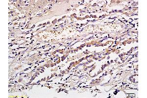 Formalin-fixed and paraffin embedded human gastric cancer labeled with Anti CD1a/Cortical thymocyte antigen CD1A Polyclonal Antibody, Unconjugated (ABIN704096) at 1:300 followed by conjugation to the secondary antibody and DAB staining (CD1a 抗体  (AA 151-250))