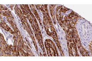ABIN6267133 at 1/100 staining Human thyroid cancer tissue by IHC-P. (LAT 抗体  (pTyr200))