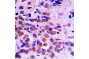 Immunohistochemical analysis of CDC2 staining in human breast cancer formalin fixed paraffin embedded tissue section. (CDK1 抗体  (Center))