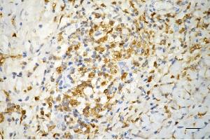Immunohistochemistry was performed on paraffin-embedded human pancreatic adenocarcinoma using ferritin light chain antibody (ABIN7798597), 1:200). (FTL 抗体)