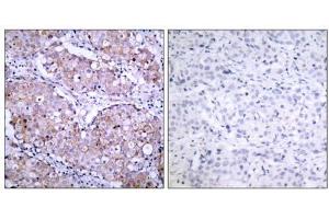 Immunohistochemical analysis of paraffin- embedded human breast carcinoma tissue, using (EGFR 抗体  (pSer1070))