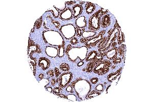 Prostatic adenocarcinoma Gleason 336 with strong AGR2 staining of all tumor cells (Recombinant AGR2 抗体)