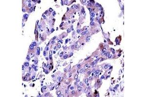 AKT2 antibody immunohistochemistry analysis in formalin fixed and paraffin embedded human lung adenocarcinoma. (AKT2 抗体  (AA 93-123))