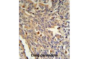 GLA Antibody (N-term) IHC analysis in formalin fixed and paraffin embedded human Lung carcinoma followed by peroxidase conjugation of the secondary antibody and DAB staining.