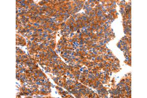 Immunohistochemistry of Human thyroid cancer using SEPT4 Polyclonal Antibody at dilution of 1:50 (Septin 4 抗体)