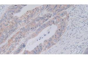 Detection of JAM2 in Human Colorectal cancer Tissue using Polyclonal Antibody to Junctional Adhesion Molecule 2 (JAM2) (JAM2 抗体  (AA 74-250))