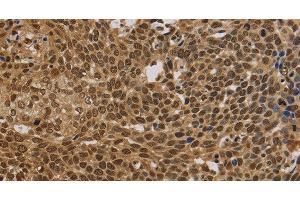 Immunohistochemistry of paraffin-embedded Human cervical cancer using BRAF Polyclonal Antibody at dilution of 1:30 (BRAF 抗体)