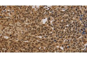 Immunohistochemistry of paraffin-embedded Human cervical cancer using BRAF Polyclonal Antibody at dilution of 1:30 (BRAF 抗体)