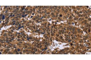 Immunohistochemistry of paraffin-embedded Human cervical cancer using EDN2 Polyclonal Antibody at dilution of 1:30 (Endothelin 2 抗体)