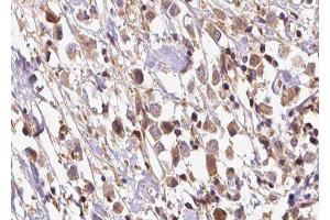 ABIN6278255 at 1/100 staining Human breast cancer tissue by IHC-P. (OS9 抗体  (Internal Region))