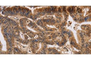 Immunohistochemistry of paraffin-embedded Human colon cancer using KCNK9 Polyclonal Antibody at dilution of 1:40 (KCNK9 抗体)