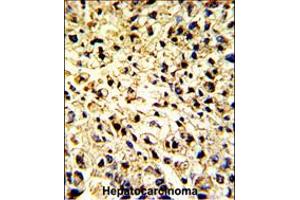 Formalin-fixed and paraffin-embedded human hepatocarcinoma with DCL-1 Antibody , which was peroxidase-conjugated to the secondary antibody, followed by DAB staining. (DCL1 抗体  (AA 143-170))