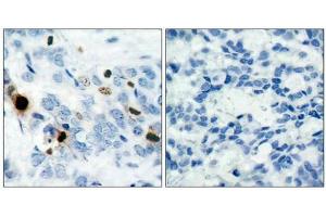 Immunohistochemical analysis of paraffin-embedded human breast carcinoma tissue using Histone H3. (HIST1H3A 抗体  (pSer10))