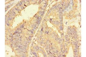 Immunohistochemistry of paraffin-embedded human endometrial cancer using ABIN7150164 at dilution of 1:100 (Retinoblastoma Binding Protein 8 抗体  (AA 126-331))