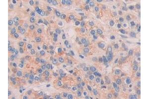 Detection of CHRD in Human Prostate cancer Tissue using Polyclonal Antibody to Chordin (CHRD) (Chordin 抗体  (AA 700-918))