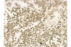 ABIN6259317 and ABIN6274541 at 1/100 staining human pituitary adenoma by IHC-P.