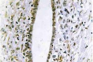 Immunohistochemistry (IHC) analyzes of Fes antibody in paraffin-embedded human liver carcinoma tissue. (FES 抗体)