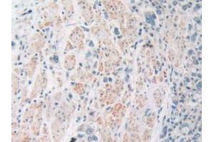IHC-P analysis of Human Stomach Cancer Tissue, with DAB staining. (SIRT4 抗体  (AA 28-314))
