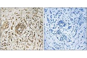 Immunohistochemistry analysis of paraffin-embedded human breast carcinoma tissue, using CIB2 Antibody. (CIB2 抗体  (AA 21-70))