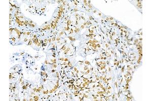 ABIN7093236 and ABIN7097248 at 1/100 staining Human lung cancer by IHC-P. (FOXO3 抗体  (acLys271))