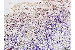 Formalin-fixed and paraffin embedded Human endometrium carcinoma labeled Anti-Livin Polyclonal Antibody, Unconjugated (ABIN672561) at 1:200, followed by conjugation to the secondary antibody and DAB staining (BIRC7 抗体  (AA 101-200))