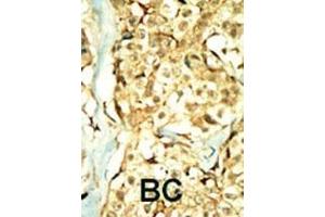 Formalin-fixed and paraffin-embedded human cancer tissue reacted with the primary antibody, which was peroxidase-conjugated to the secondary antibody, followed by DAB staining. (TNIK 抗体  (N-Term))