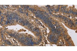 Immunohistochemistry of paraffin-embedded Human colon cancer tissue using KCNG1 Polyclonal Antibody at dilution 1:40 (KCNG1 抗体)
