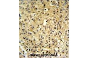 FYTD1 Antibody (N-term) (ABIN651416 and ABIN2840226) IHC analysis in formalin fixed and paraffin embedded human cervix carcinoma followed by peroxidase conjugation of the secondary antibody and DAB staining. (FYTTD1 抗体  (N-Term))