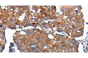 Immunohistochemistry of paraffin-embedded Human breast cancer using FGF2 Polyclonal Antibody at dilution of 1:100 (FGF2 抗体)