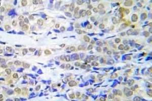 Immunohistochemistry (IHC) analyzes of FOXO4 antibody in paraffin-embedded human lung adenocarcinoma tissue. (FOXO4 抗体)