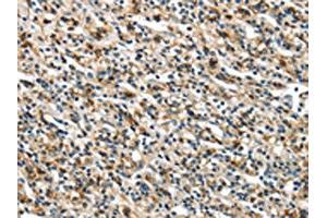 The image on the left is immunohistochemistry of paraffin-embedded Human prostate cancer tissue using ABIN7129612(GLP2R Antibody) at dilution 1/30, on the right is treated with fusion protein. (GLP2R 抗体)