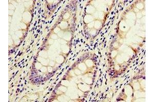 Immunohistochemistry of paraffin-embedded human colon cancer using ABIN7143229 at dilution of 1:100 (ACSM3 抗体  (AA 387-586))