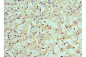 Immunohistochemistry of paraffin-embedded human liver cancer using ABIN7145593 at dilution of 1:100 (SULT2A1 抗体  (AA 1-145))