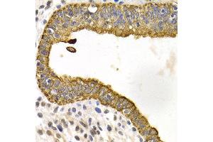 Immunohistochemistry of paraffin-embedded human metrocarcinoma using KRT5 antibody at dilution of 1:200 (400x lens). (Cytokeratin 5 抗体)