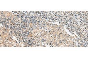 Immunohistochemistry of paraffin-embedded Human cervical cancer tissue using POLR2L Polyclonal Antibody at dilution of 1:45(x200) (POLR2L 抗体)